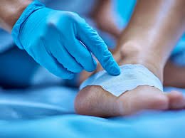 Diabetic Ulcer
